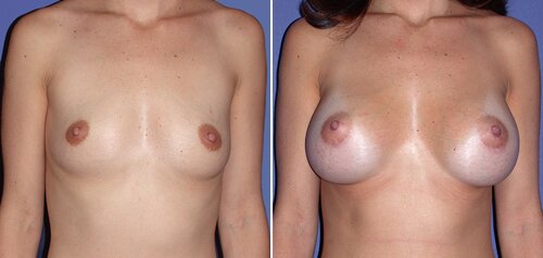 Miami breast enlargement plastic surgery patient photos