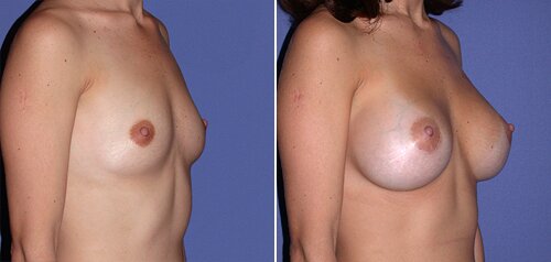 Miami breast enlargement plastic surgery patient photos